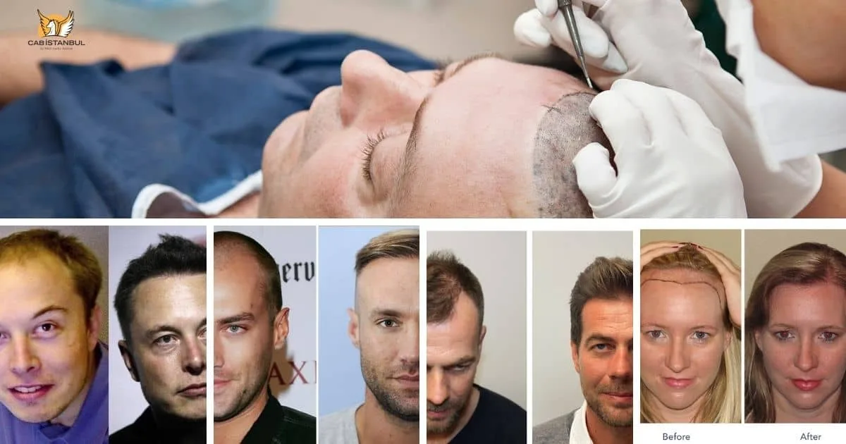 Top Hair Clinics Istanbul Turkey