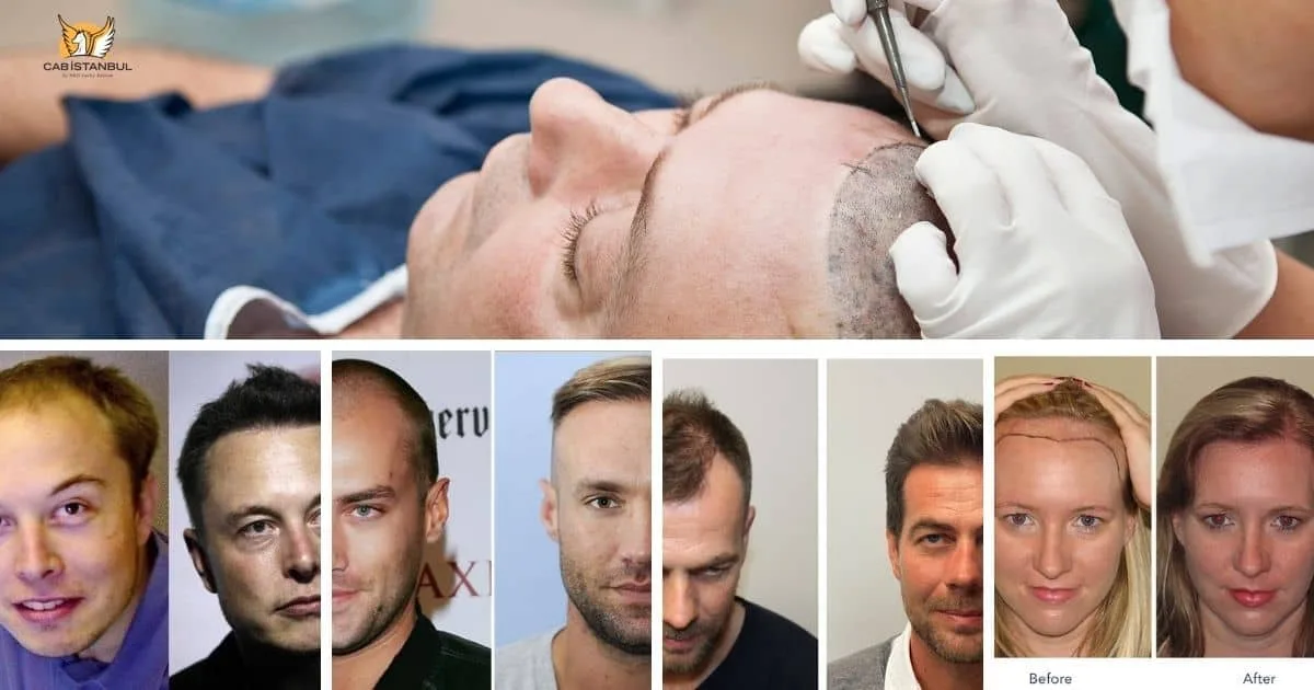 زراعة الشعر في اسطنبول