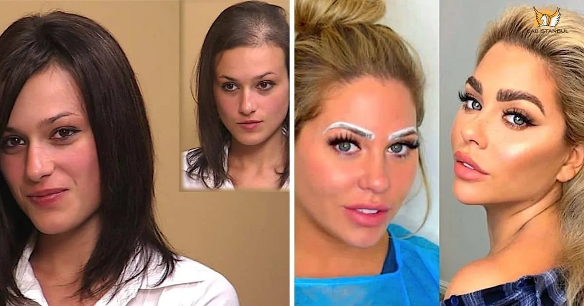 Turkish Hair Transplant