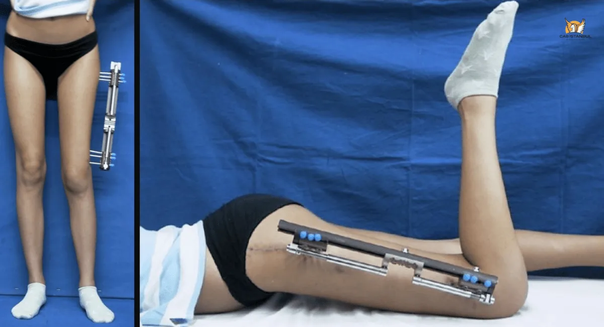 Limb Lengthening Surgery Istanbul