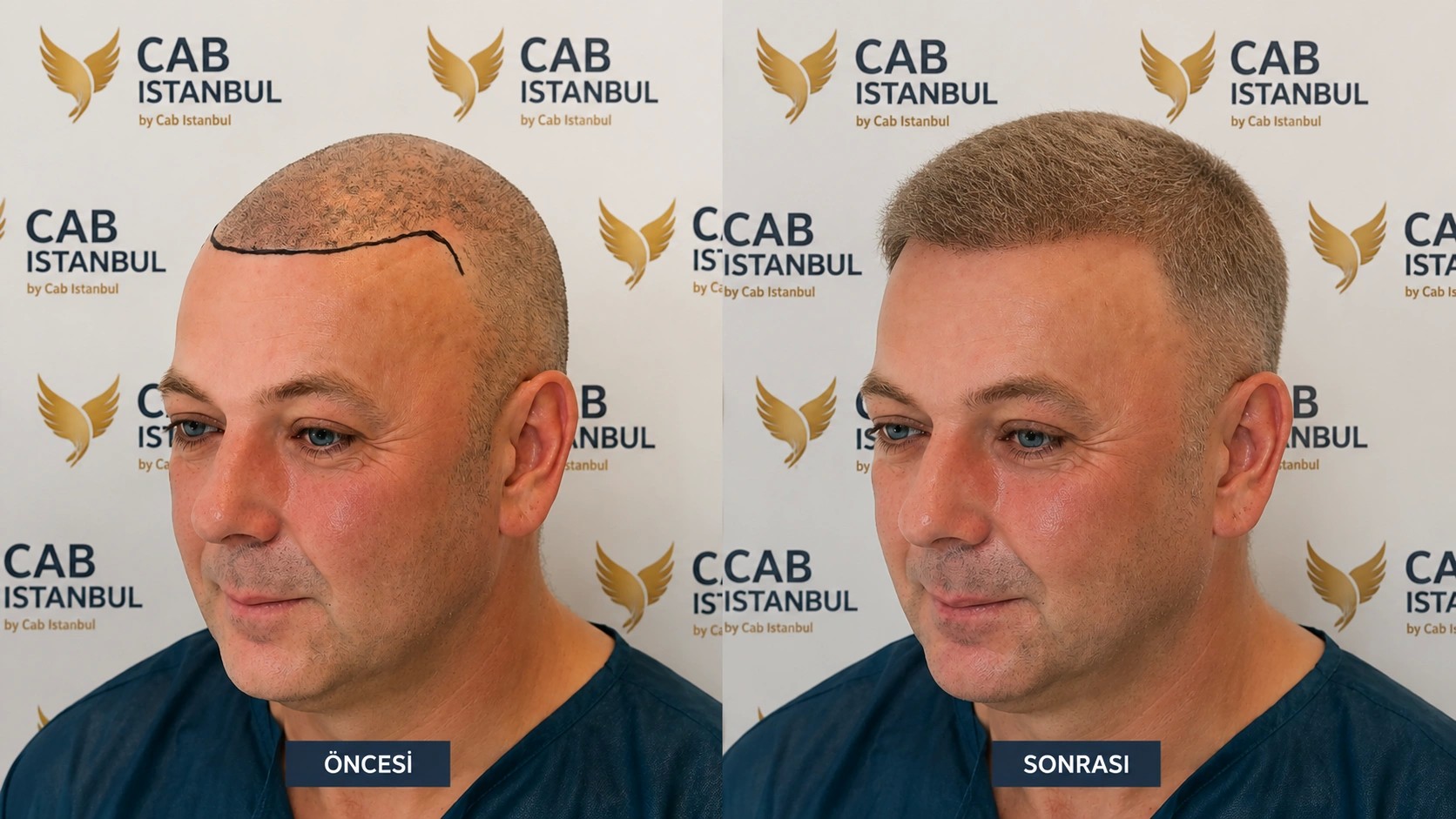 أفضل مراكز زراعة الشعر في إسطنبول 2026 — دليل شامل للمرضى الخليجيين