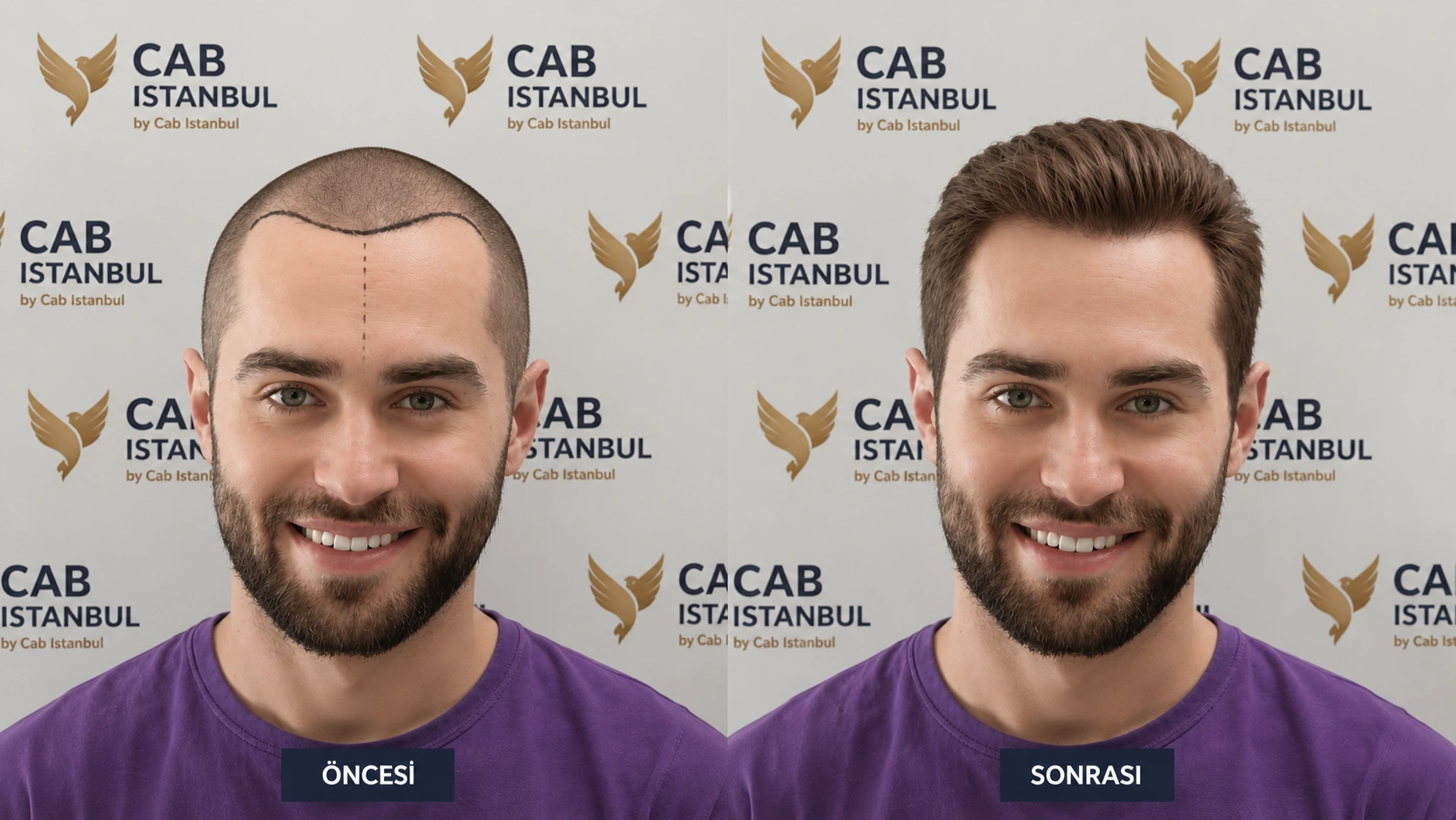 Private car transfer between hotel and clinic in Istanbul — Mercedes for hair transplant visitor