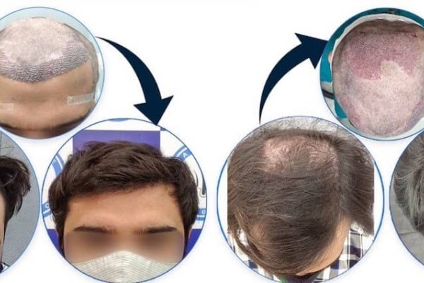 زراعة الشعر في تركيا إسطنبول