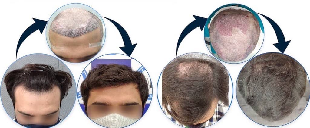 زراعة الشعر في تركيا إسطنبول