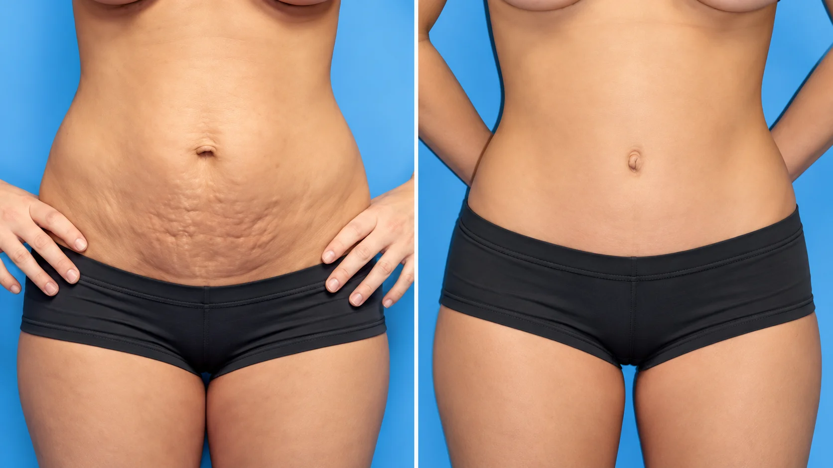Karın germe abdominoplasti İstanbul plastik cerrahi